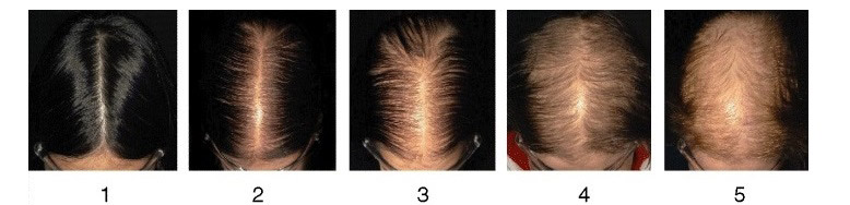 Female Hair Plantation - The Best Female Hair Transplant Turkey - Female Hair Transplant Best Cost Turkey