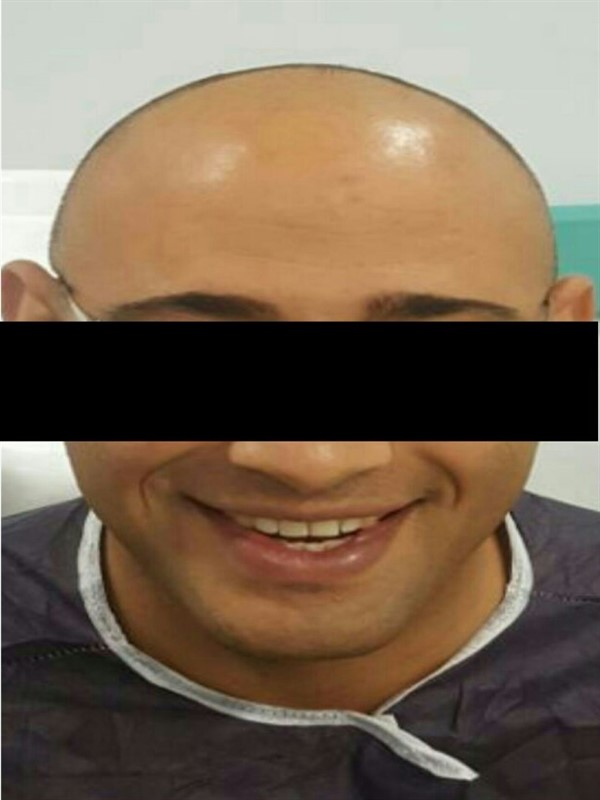 Hair Transplant Results - Hair Transplant Turkey Results - Hair Transplant Turkey Before and After