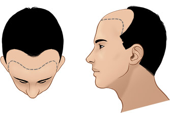 Norwood Scale For Hair Transplant - Norwood Scale Baldness - Norwood Hamilton Scale
