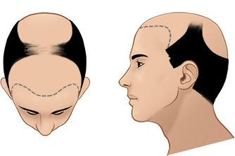 Norwood Scale For Hair Transplant - Norwood Scale Baldness - Norwood Hamilton Scale
